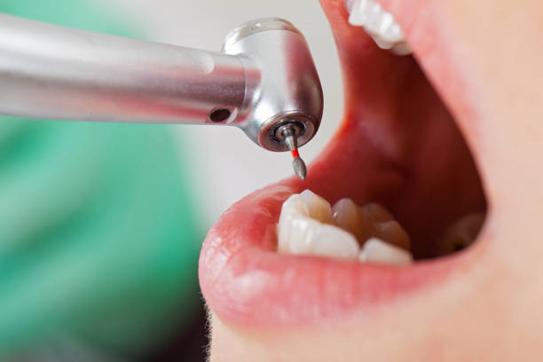 Best Walk-In Emergency Dentist in Decordova, TX